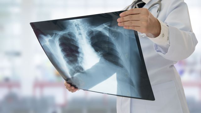 Doctor holding an x-ray of lungs looking for signs of lung cancer.