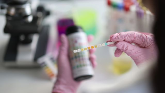 A lab technician checks a urine sample in a medical lab. High levels of protein in the urine are a predictor of complications in kidney disease.